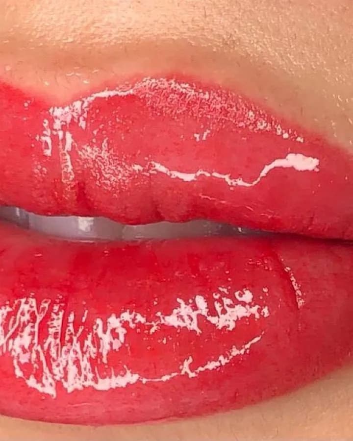 Resultado de hidragloss labial: lábios hidratados e com brilho após o procedimento de estética facial